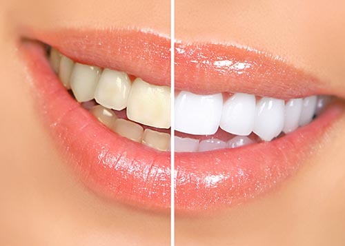 برای سفید کردن دندان از روغن افتابگردان استفاده کنید