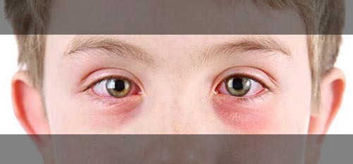 یکی از علل پف زیر چشم حساسیت و آلرژی است