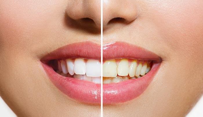 سفید کردن دندان بصورت طبیعی
